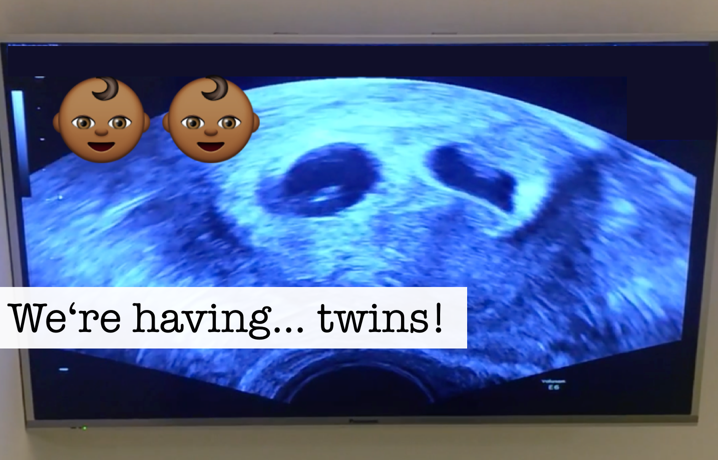 Schwangerschaft Zwillinge
